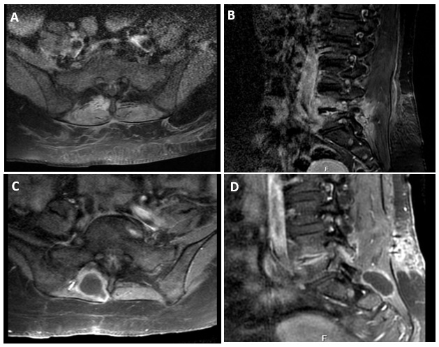 (A, B, C, D): Axial and sagittal T1-weighted with contrast sections of magnetic resonance imaging (MRI) are the after fifth operative early view. The axial and sagittal T1-weighted images with contrast enhancement showed a posterior paravertebral mass with a peripheral rim in the last MRI.